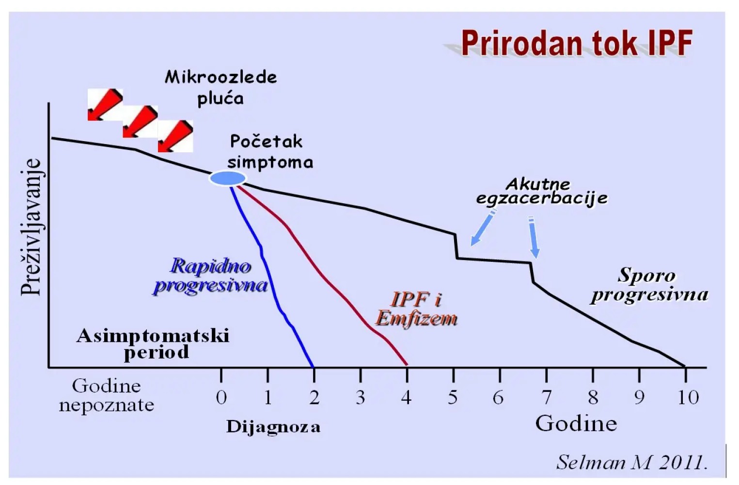 Intersticijske bolesti pluća