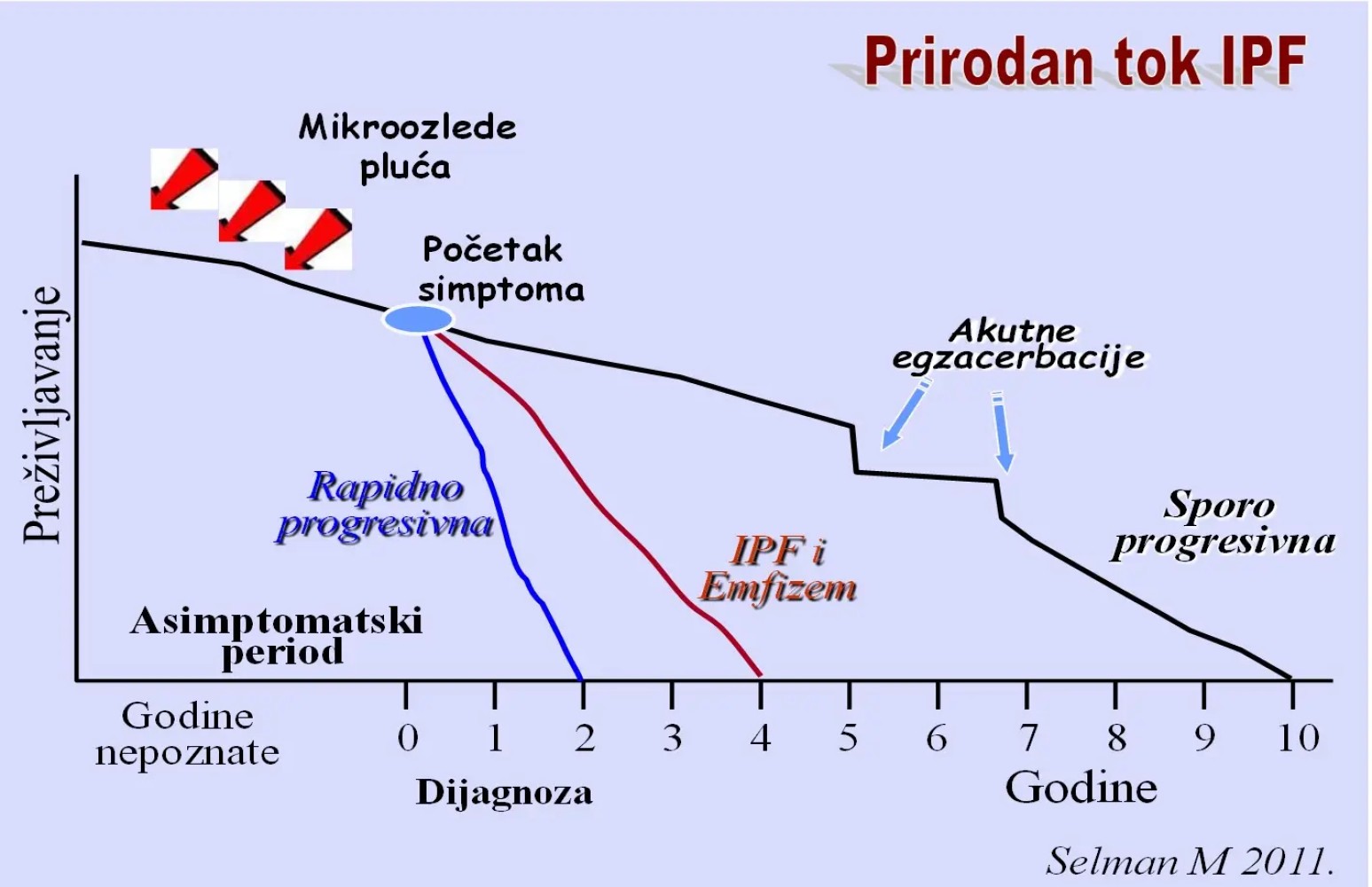 Intersticijske bolesti pluća