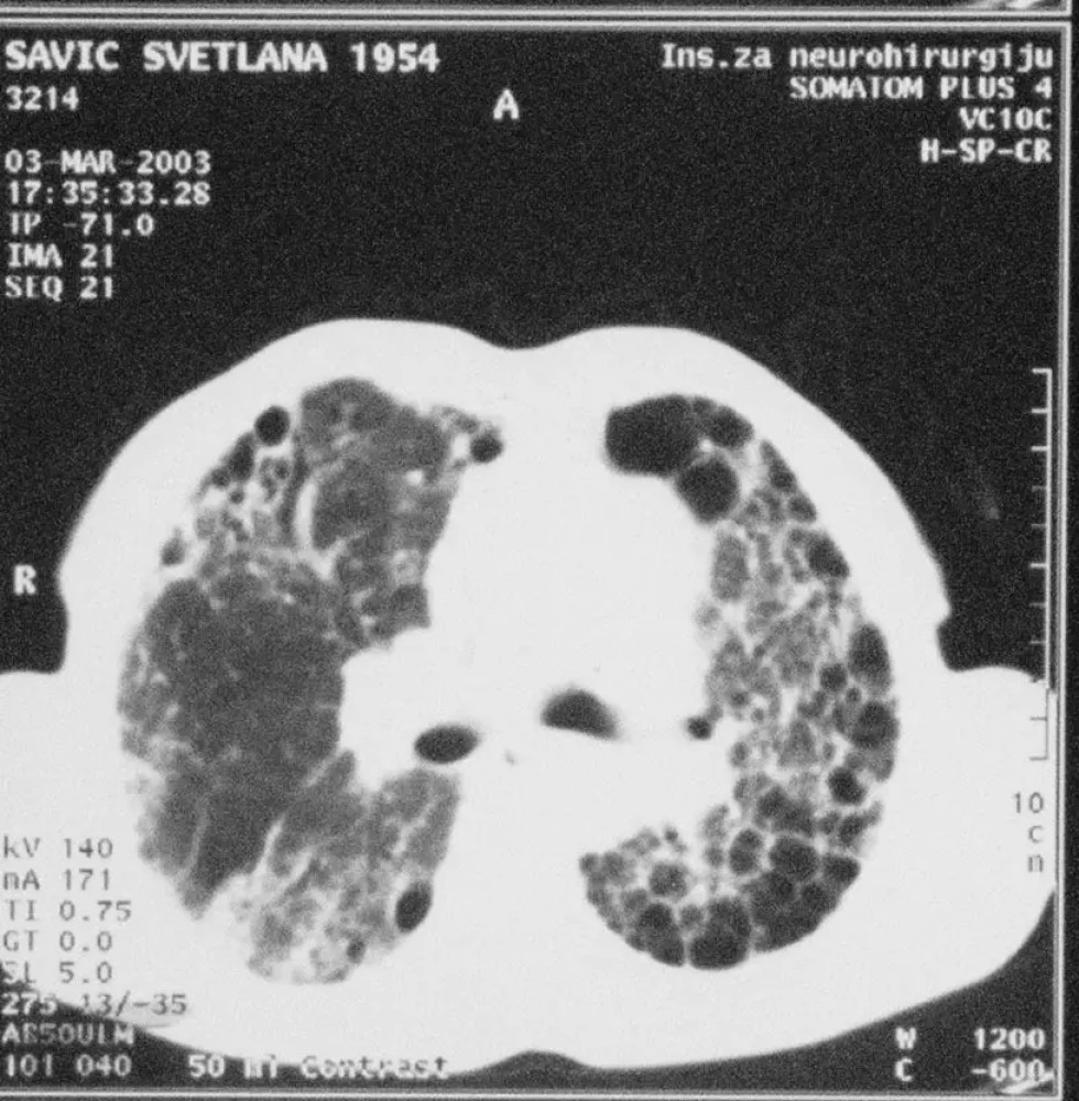 Intersticijske bolesti pluća