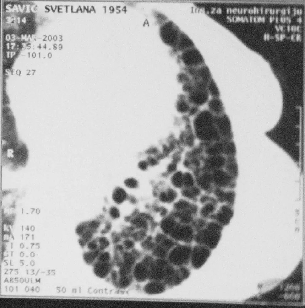 Intersticijske bolesti pluća